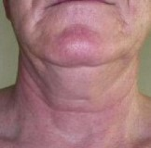 Before/After Image